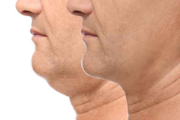HIFU - Breakthrough in Anti - ageing 2 hifu results Pinner
