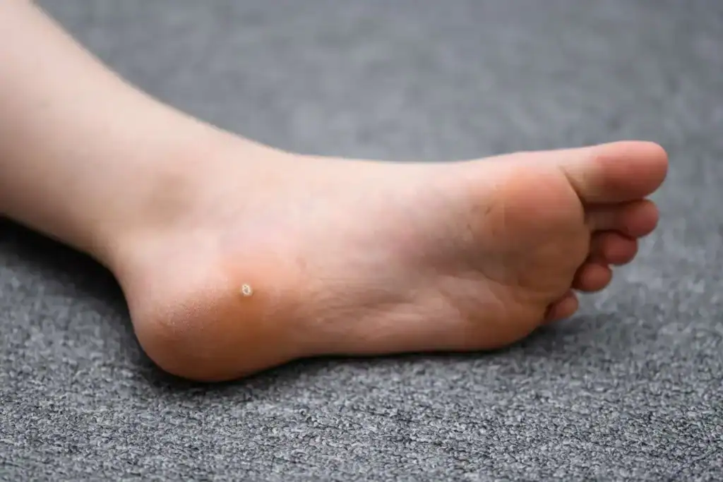 Cryotherapy For Warts And Also Verrucas 2 Image of verruca on the bottom of the foot that able to be treated with Cryotherapy Pinner