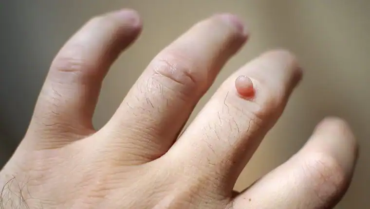 Image of blemish that Cryotherapy Pinner can remove with Lipo 360.