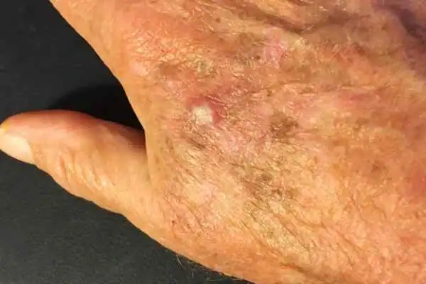 Cryopen For Actinic Keratoses 1 Image of Actinic keratoses Pinner on a person hand