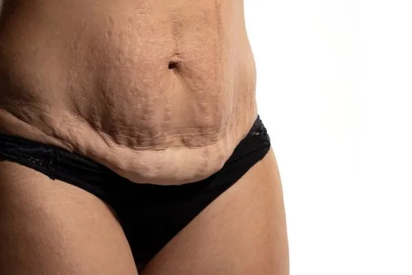 The Science of Skin Tightening 1 The science behind skin tightening Pinner picture of a woman's sagging skin on the stomach